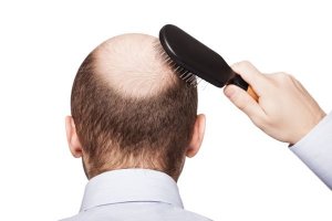Queda de cabelo: mitos e verdades